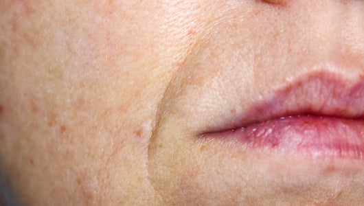 microneedling for smile lines