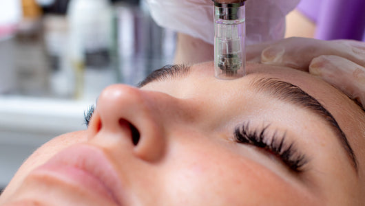 is microneedling safe