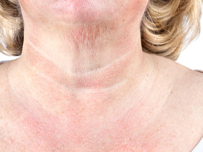 microneedling for crepey skin