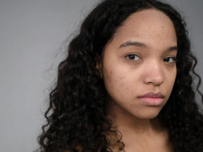 microneedling for acne scars