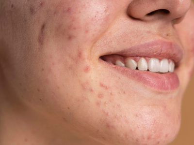 The Dirty Truth: 6 Everyday Habits that Are Causing Breakouts