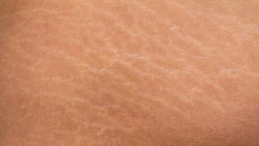 Red Light Therapy Stretch Marks
