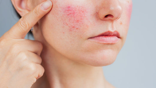 Woman with skin irritation, wondering does red light therapy help heal wounds_jpeg