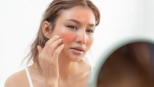 Women with sunburn on face considering red light therapy for the sunburn.