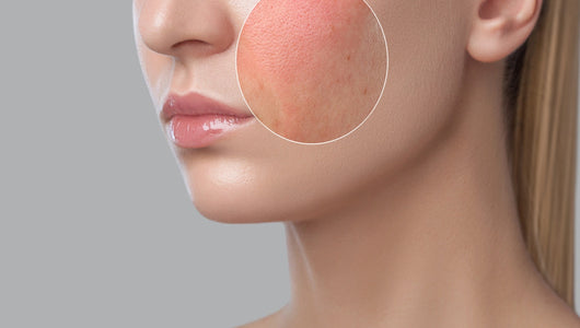 Zoom in on irritated skin that is falsely attributed as red light therapy detox symptoms.