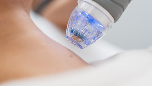 microneedling after one session