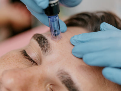 micro needling recovery time