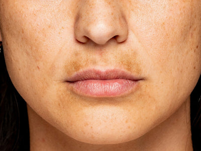 does red light therapy help fade dark spots