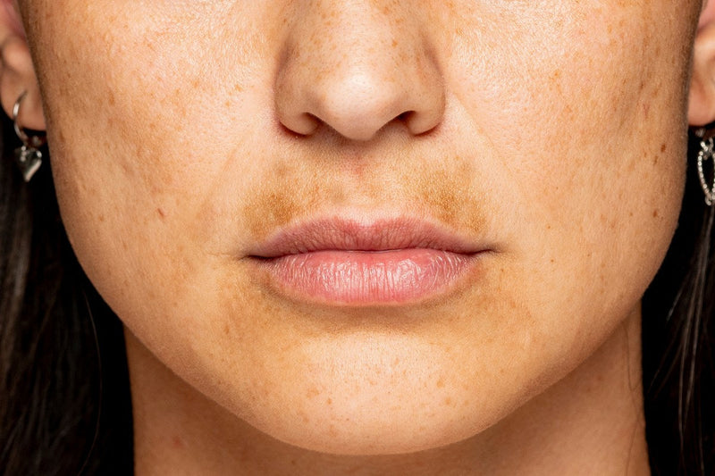 does red light therapy help fade dark spots
