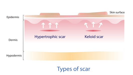 red light therapy keloid scars