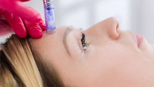 microneedling sensitive skin