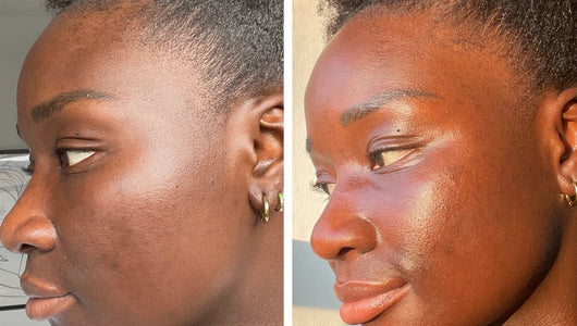 microneedling black skin