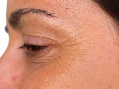 microneedling crows feet