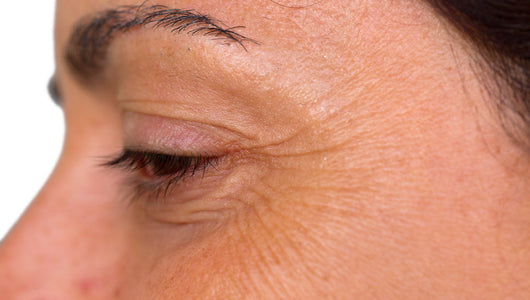 microneedling crows feet