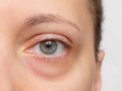 microneedling under eyes