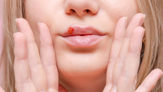 Red Light Therapy for Cold Sores