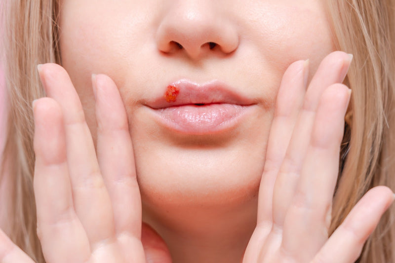 Red Light Therapy for Cold Sores