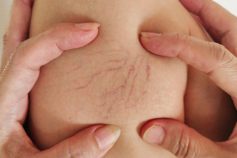 Red Light Therapy for Varicose Veins