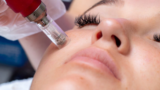 is microneedling permanent
