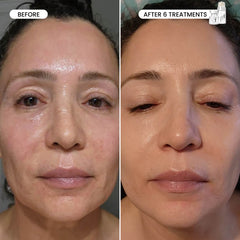 Micro-Infusion 1 Month Bundle (For Wrinkles)