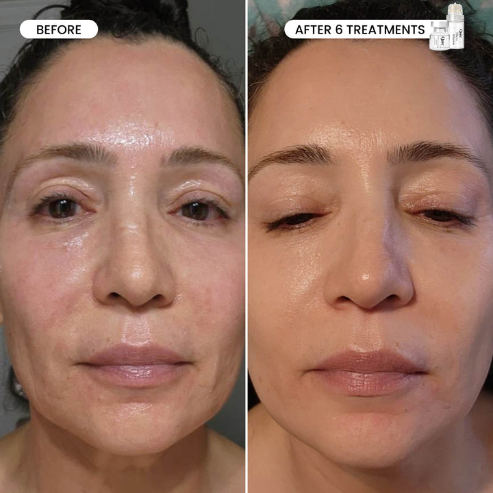 Micro-Infusion 3 Month Bundle (For Dark Spots)