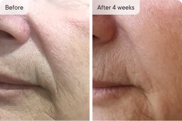 Anti-aging results