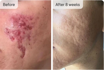 Anton's acne before and after 8 weeks