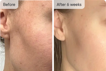 Bethany's skin transformation after 6 weeks