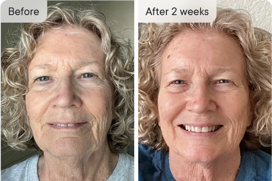 Cheryl's face after 2 weeks - before and after comparison.
