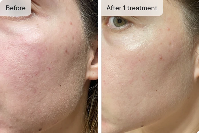 ela skin treatment before and after one treatment