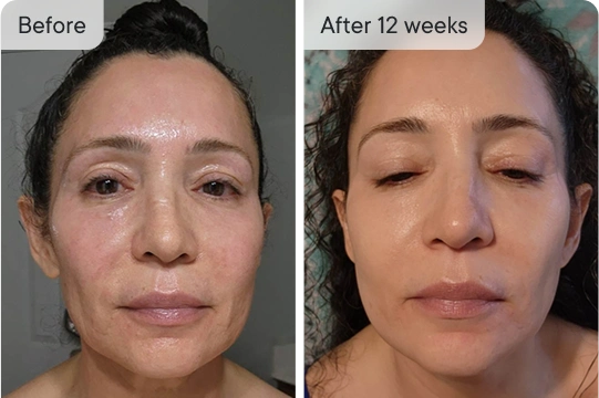 Before & after 12 weeks