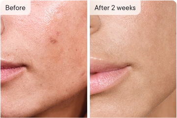 Hanna's skin before and after 2 weeks, improved complexion.