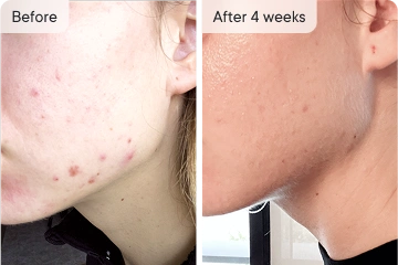 Kim's acne treatment results after 4 weeks