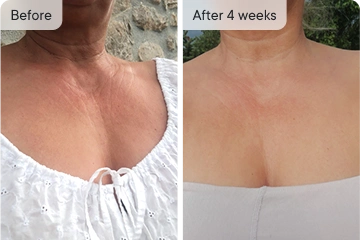 Mary's chest skin improvement after 4 weeks