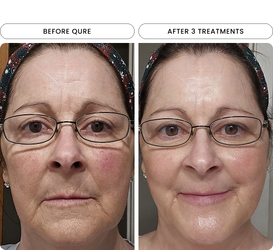 Micro-Infusion 3 Month Bundle (For Wrinkles) (Pre-order)