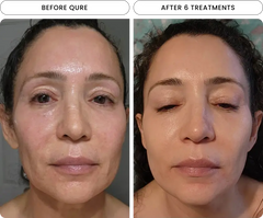 Micro-Infusion 6 Month Bundle (For Wrinkles)
