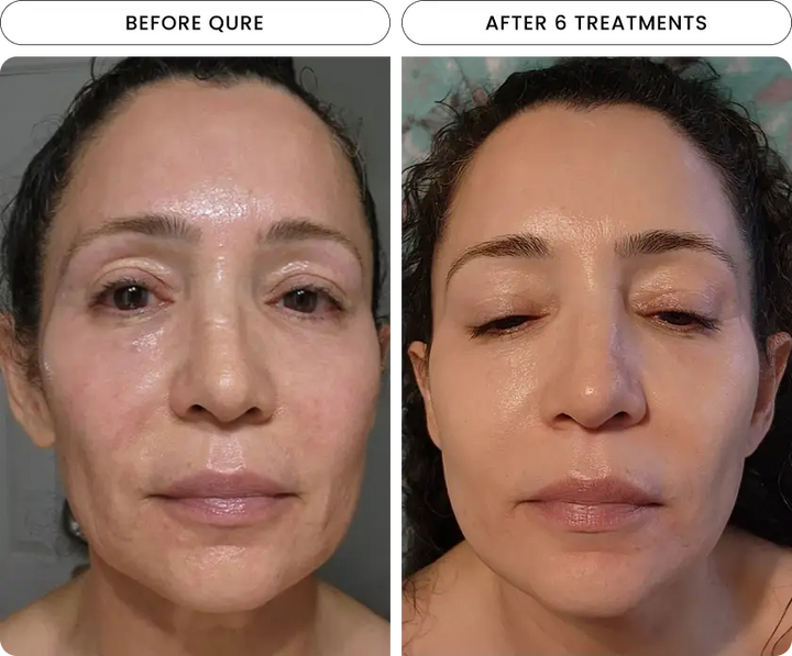 Micro-Infusion 6 Month Bundle (For Dark Spots) (Pre-Order)