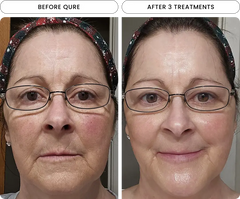 Micro-Infusion 6 Month Bundle (For Dark Spots) (Pre-Order)