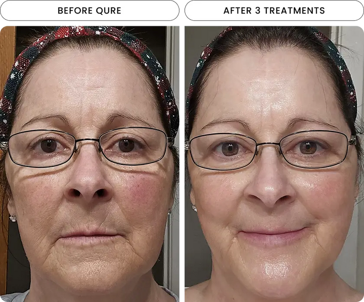 Micro-Infusion 6 Month Bundle (For Dark Spots) (Pre-Order)