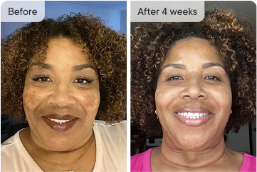 Before & After 4 weeks