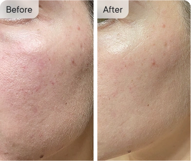 Before & After skin improvement
