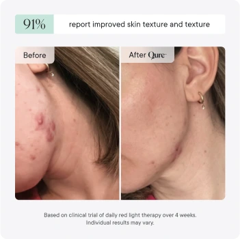 Q-Rejuvalight Pro facewear