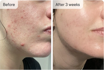 acne treatment results