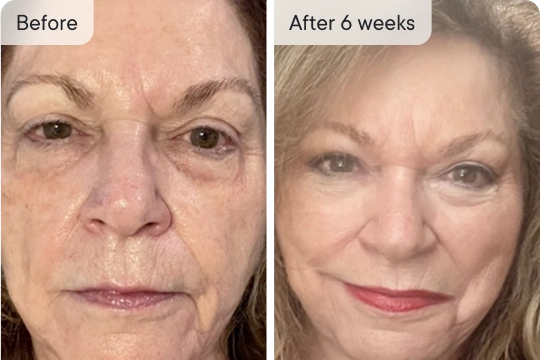 Before & After 6 weeks.