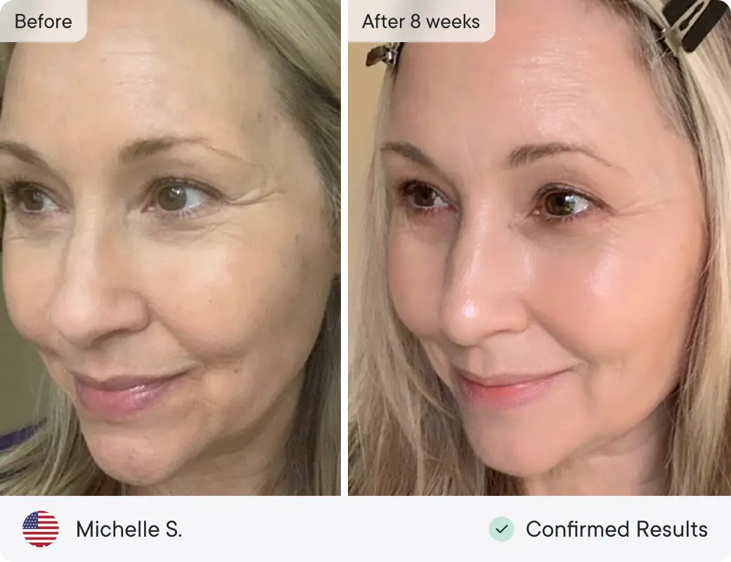 Anti-aging transformation results for Michelle S.